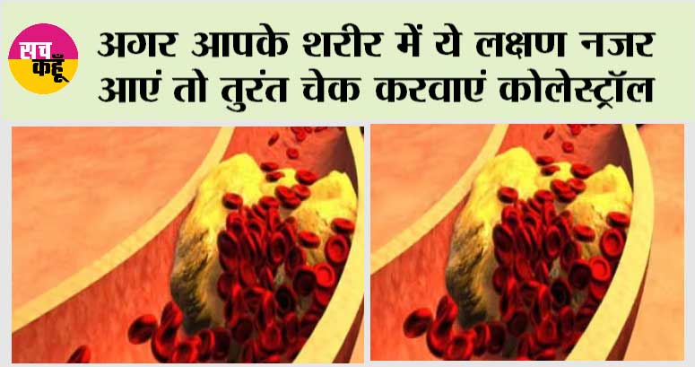 Signs your arteries full of cholesterol