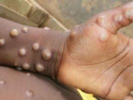 Monkeypox