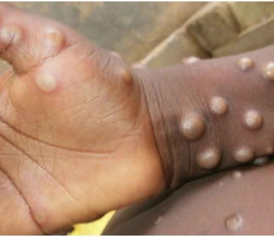 Monkeypox Virus